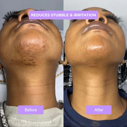 Viralaluna™ - Cyperus Rotundus Skin Serum