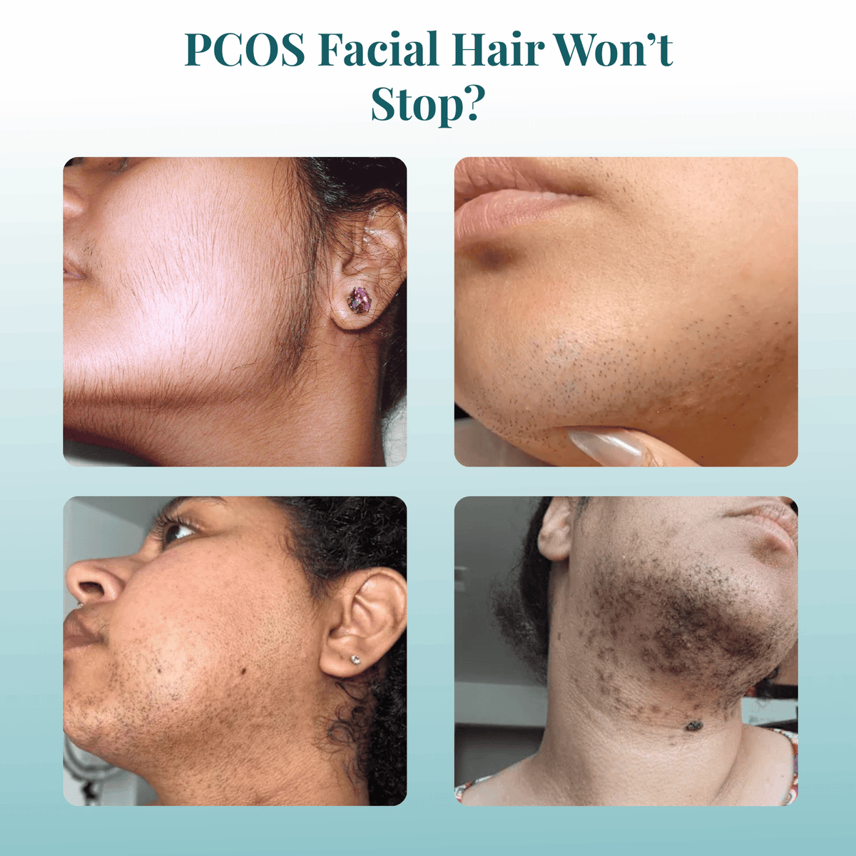 Painless Hormonal Hair Remover - No Redness, No Thicker Regrowth